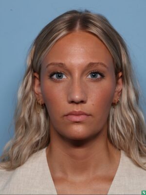 Rhinoplasty
