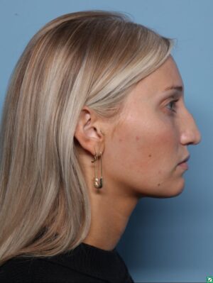 Rhinoplasty
