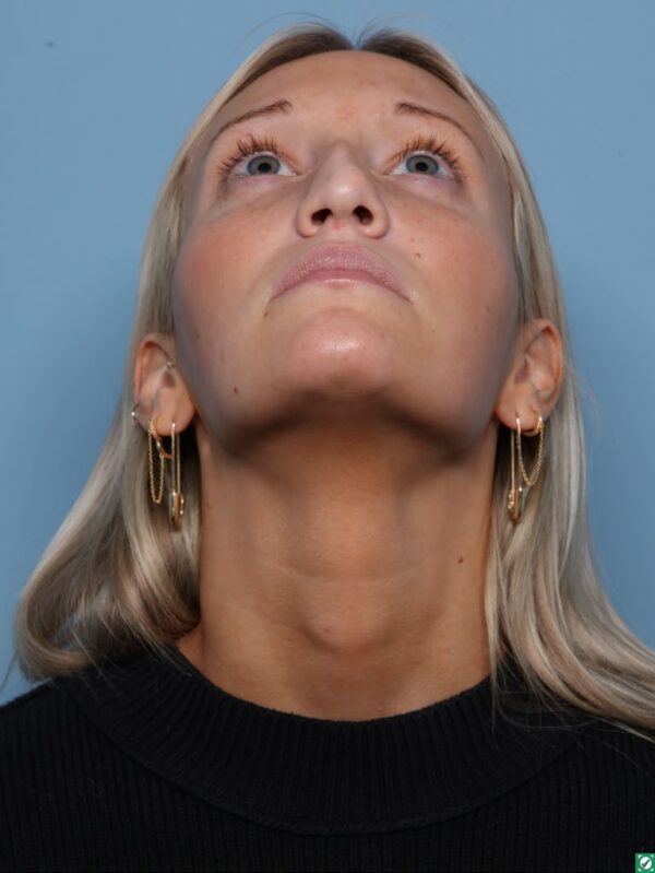 Rhinoplasty