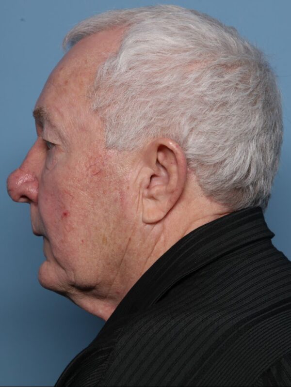 Rhinophyma Excision
