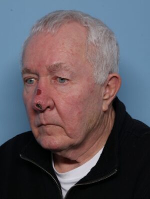 Skin Cancer Reconstruction
