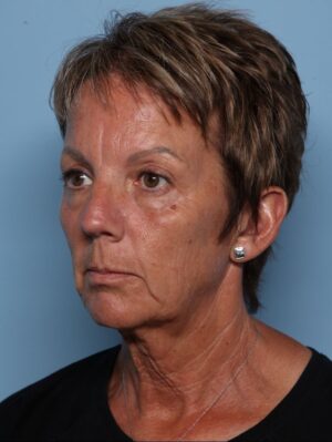 Brow Lift