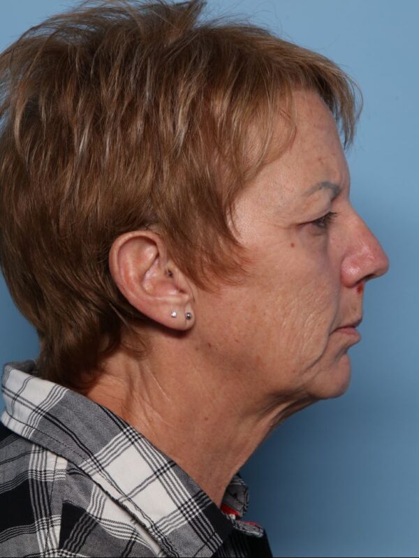 Blepharoplasty
