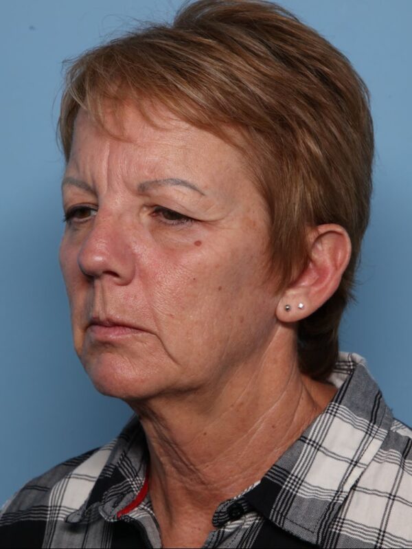 Blepharoplasty