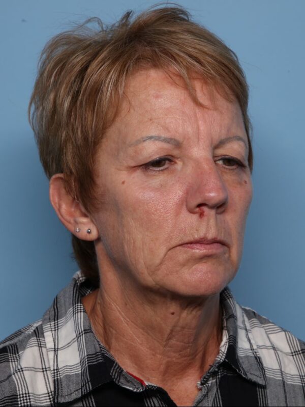 Blepharoplasty