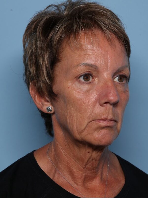 Blepharoplasty