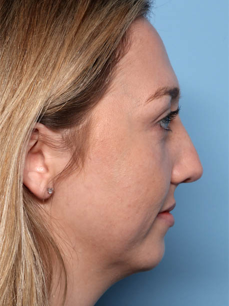Facial Fillers