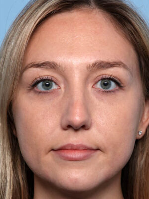 Facial Fillers