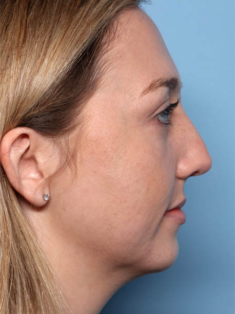 Facial Fillers
