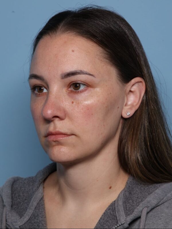 Allura Laser-Assisted Submental Lipolysis