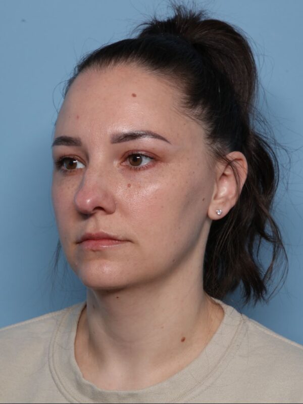 Allura Laser-Assisted Submental Lipolysis