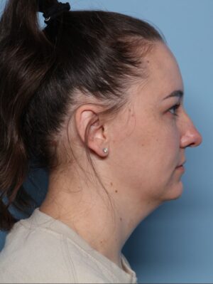 Allura Laser-Assisted Submental Lipolysis
