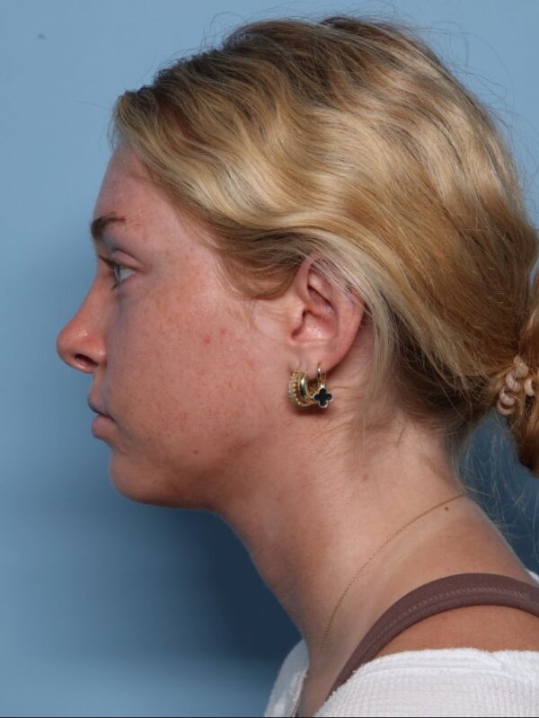 Rhinoplasty