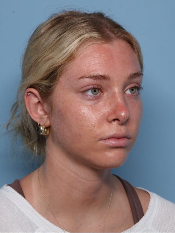 Rhinoplasty