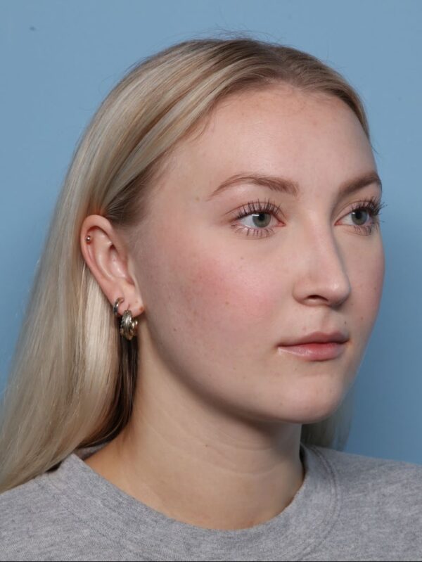 Rhinoplasty