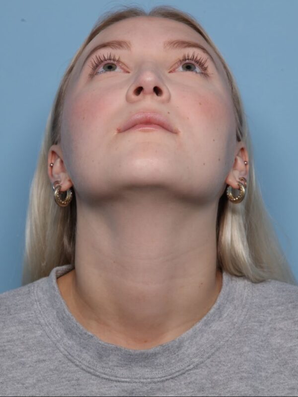 Rhinoplasty