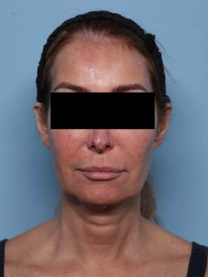 Deep Necklift
