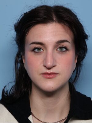 Rhinoplasty