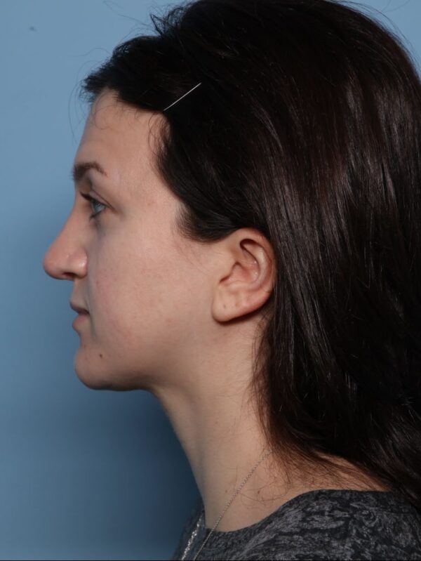 Rhinoplasty