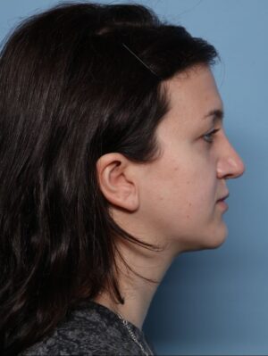 Rhinoplasty