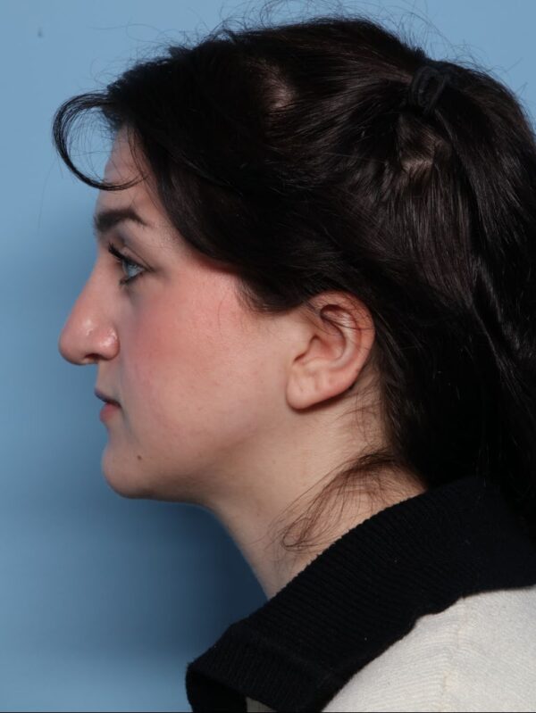 Rhinoplasty