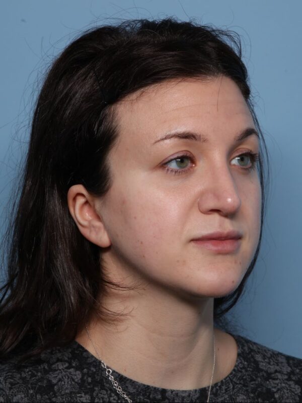 Rhinoplasty