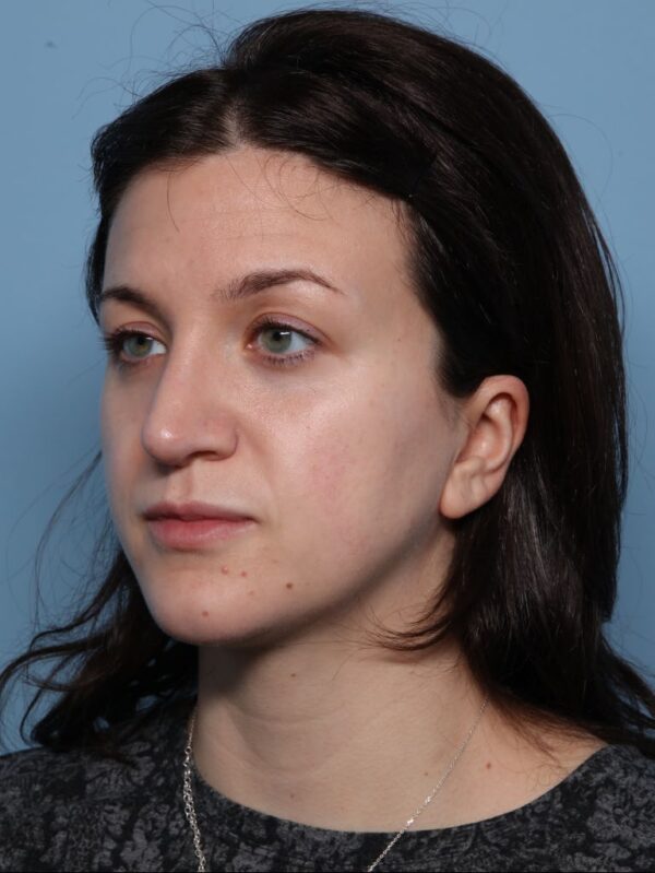 Rhinoplasty