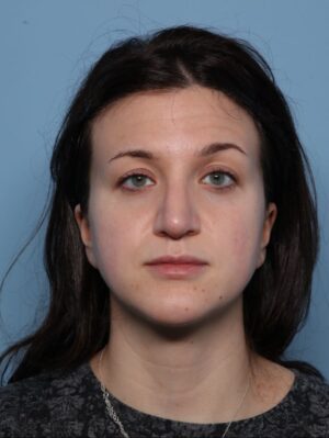 Rhinoplasty
