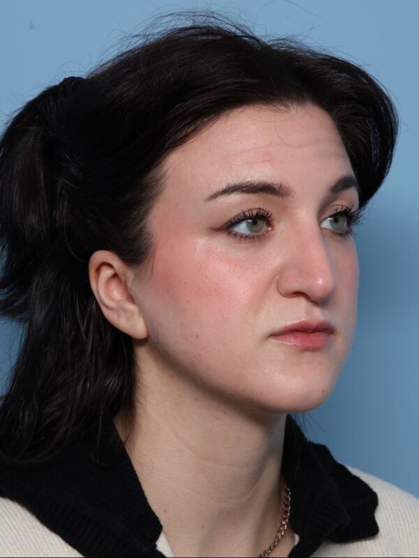 Rhinoplasty