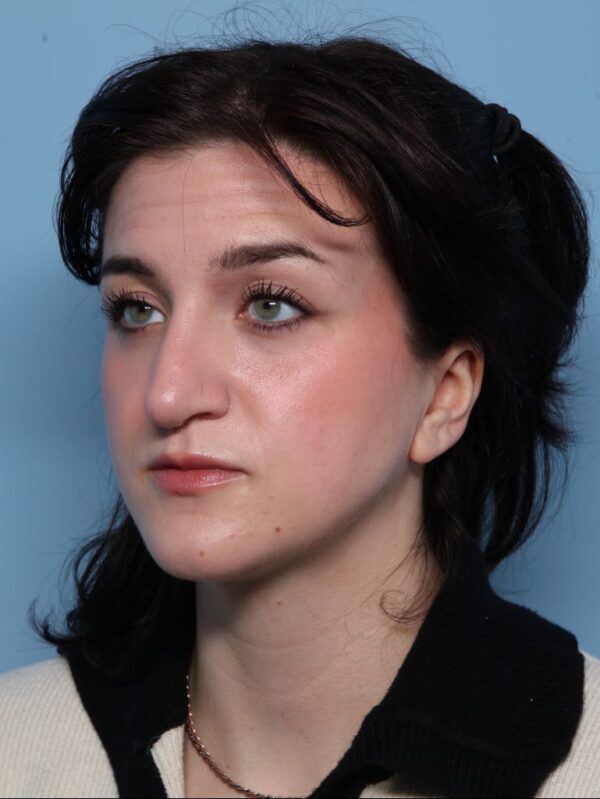 Rhinoplasty