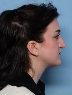 Rhinoplasty