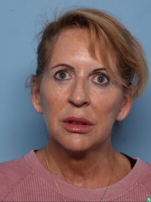 Facelift