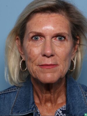 Facelift