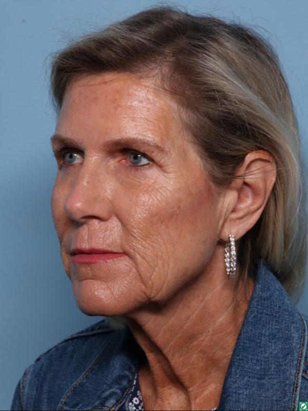 Facelift