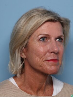 Facelift