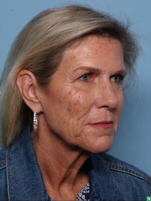 Facelift