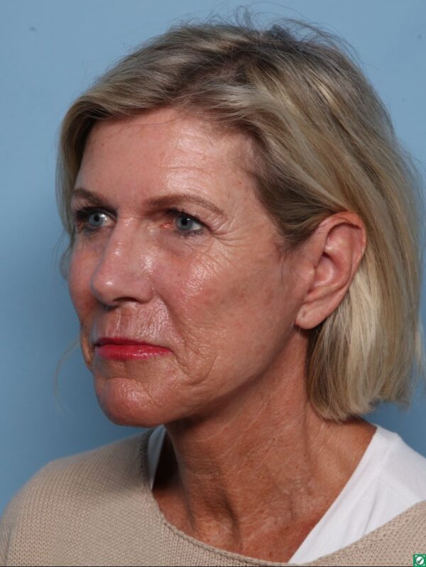 Facelift