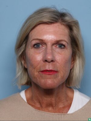 Facelift