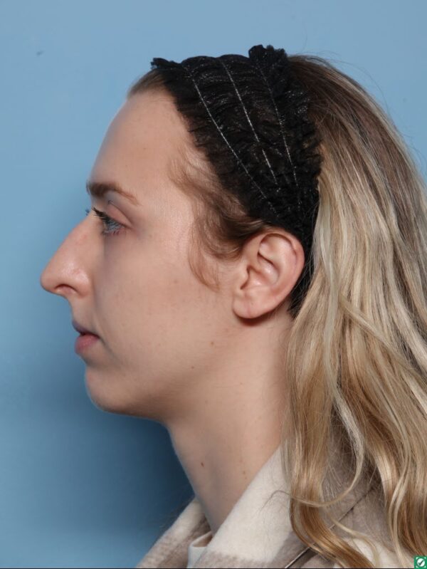 Rhinoplasty