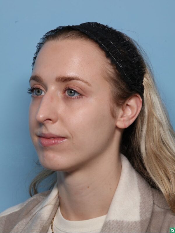 Rhinoplasty