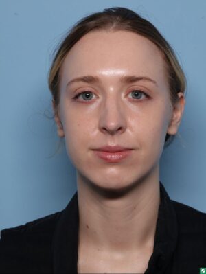 Rhinoplasty