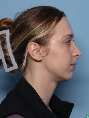 Rhinoplasty