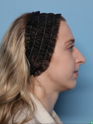 Rhinoplasty