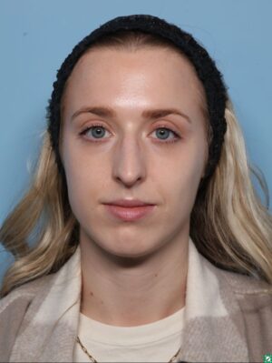 Rhinoplasty