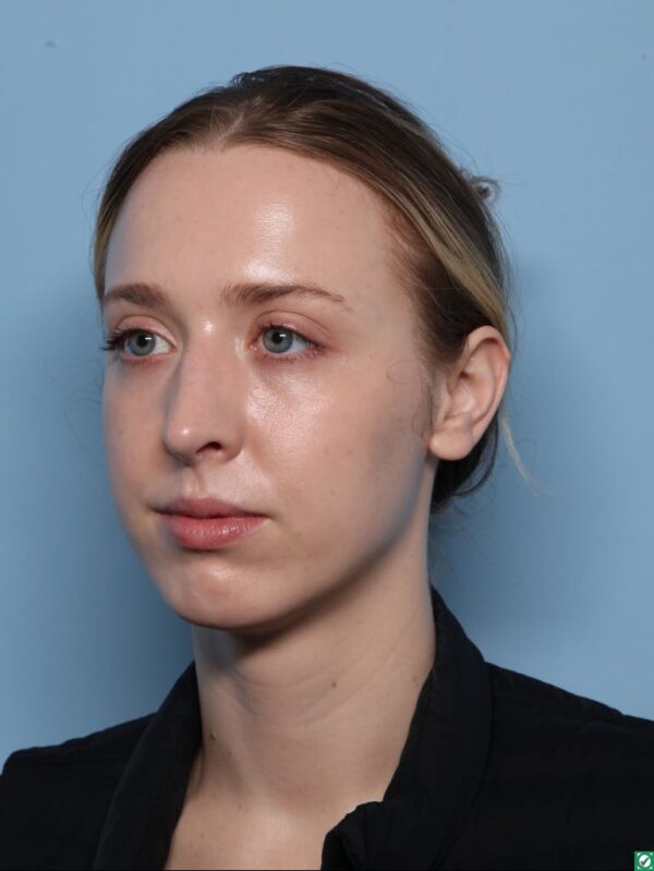 Rhinoplasty