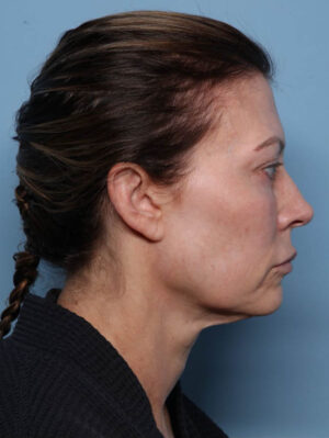 Deep Necklift