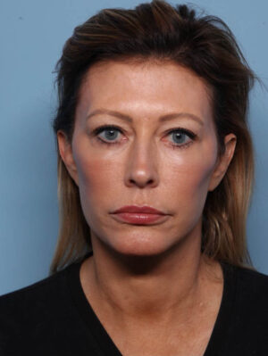 Deep Necklift