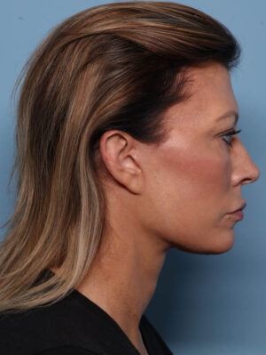 Deep Necklift