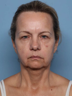 Deep Necklift