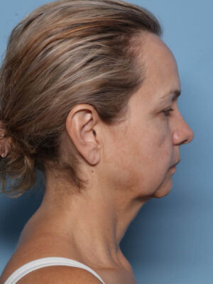 Deep Necklift